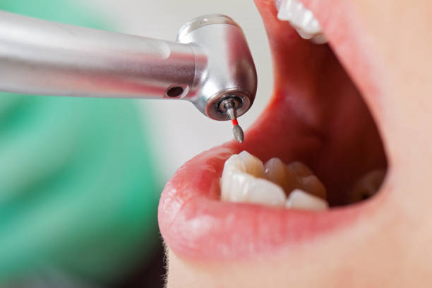 Best Emergency Root Canal Treatment in Palmer, AK